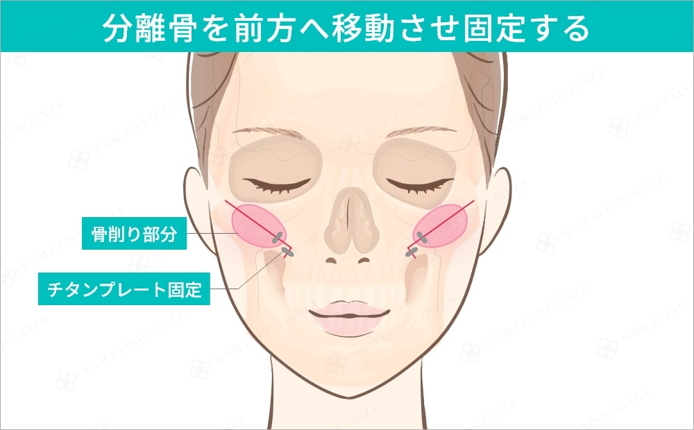 分離骨を前方へ移動させ固定させる