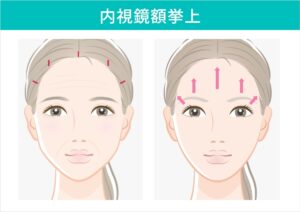 内視鏡額挙上