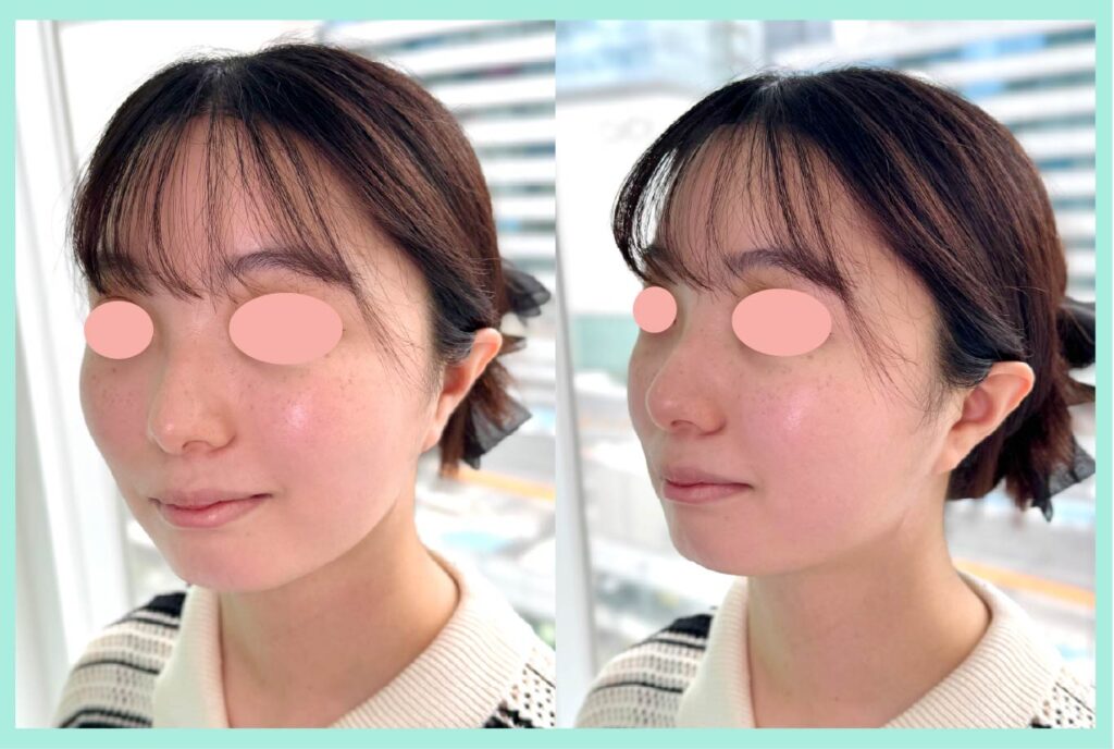 『ベース型の輪郭を骨切りなしでなるべく工夫してしっかり細くする!』の画像