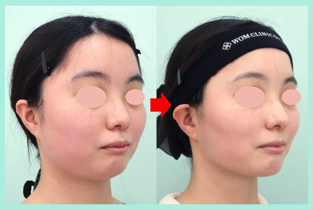 『ベース型の輪郭を骨切りなしでなるべく工夫してしっかり細くする!』の画像
