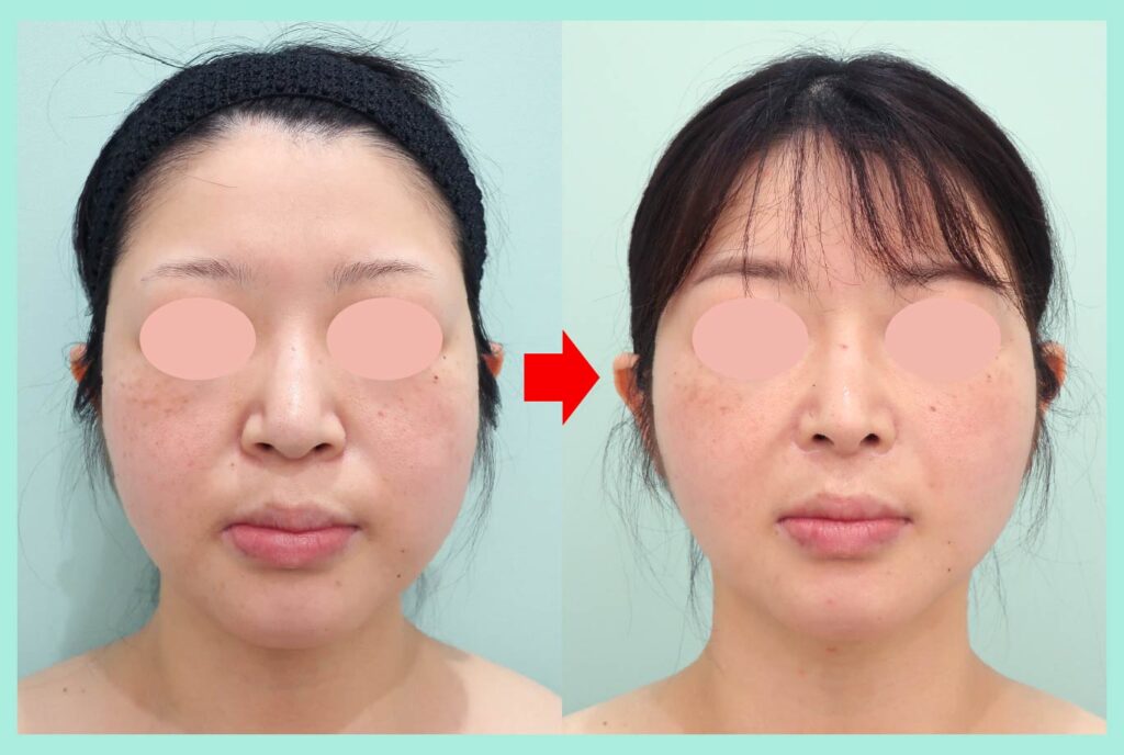 『術後3年経過しても圧倒的な結果で満足度MAXの脂肪吸引治療』の画像