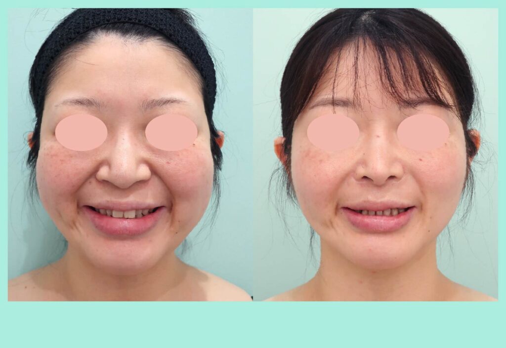 『術後3年経過しても圧倒的な結果で満足度MAXの脂肪吸引治療』の画像