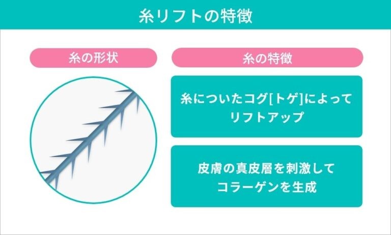 糸リフトの特徴と、トゲ状の糸の解説図