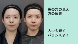 鼻フル整形の症例写真02
