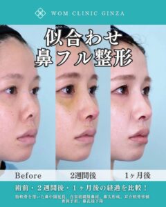 鼻フル整形の症例写真03
