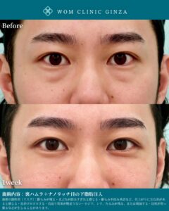 『【男性クマ治療】明るく若々しい印象に!裏ハムラ+ナノリッチで自然なイケメン顔へ』の画像