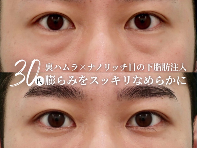 裏ハムラ、ナノリッチ