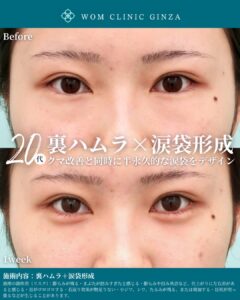 『裏ハムラと涙袋形成の相乗効果で理想の目元に!中顔面を若返らせる最新美容術』の画像