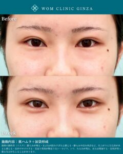 『裏ハムラと涙袋形成の相乗効果で理想の目元に!中顔面を若返らせる最新美容術』の画像