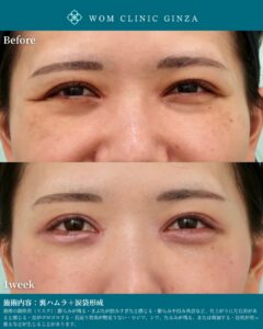 『ダウンタイム最小限の裏ハムラ+涙袋形成で自然な美しさと笑顔を実現』の画像