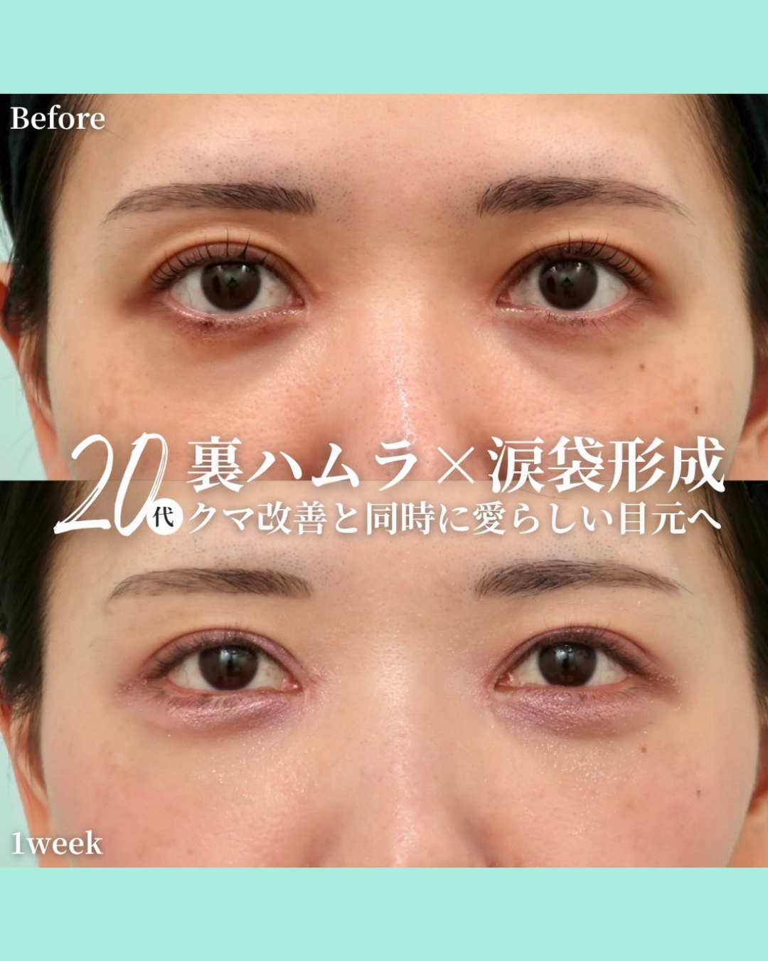 裏ハムラ 涙袋形成