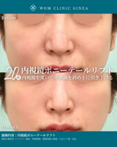 『ポニーテールリフトで中顔面を若返らせる!切開不要で自然な引き上げ効果を実感』の画像