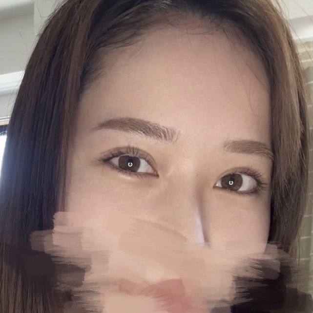 爆美女クマ整形 AFTER写真