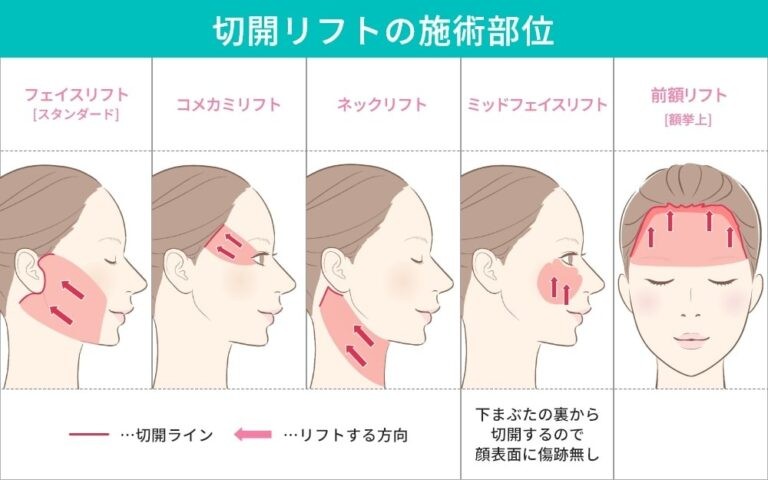 切開リフトの施術部位とリフトの方向を示す図解