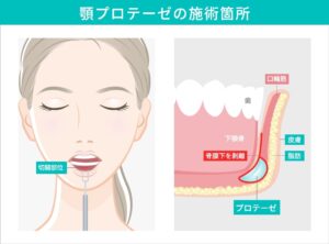 顎プロテーゼの施術箇所