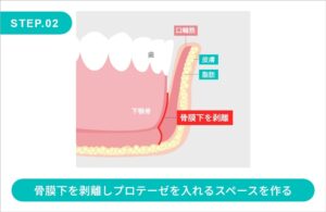 顎プロテーゼの施術方法　STEP.2