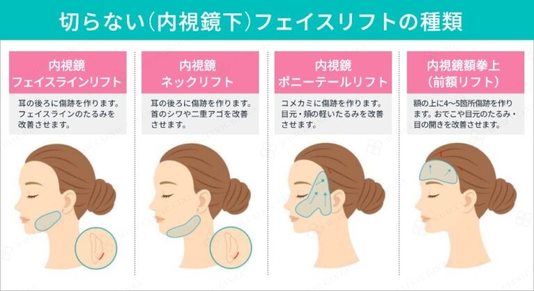 切らないフェイスリフトの種類と施術部位