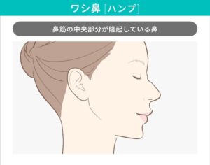 鷲鼻
