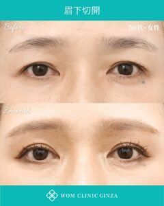 眉下切開の症例写真