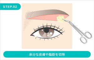 眉下切開の施術方法　STEP.2