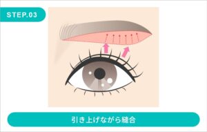 眉下切開の施術方法　STEP.3