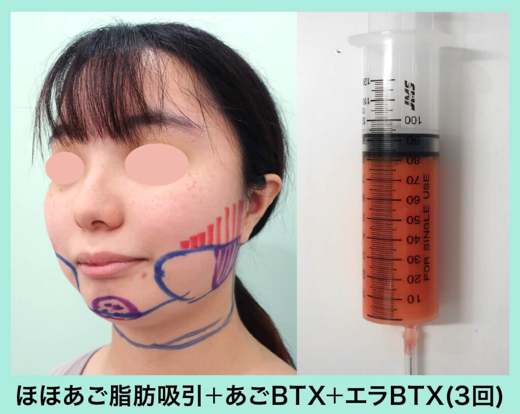 『ベース型の輪郭を骨切りなしでなるべく工夫してしっかり細くする!』の画像
