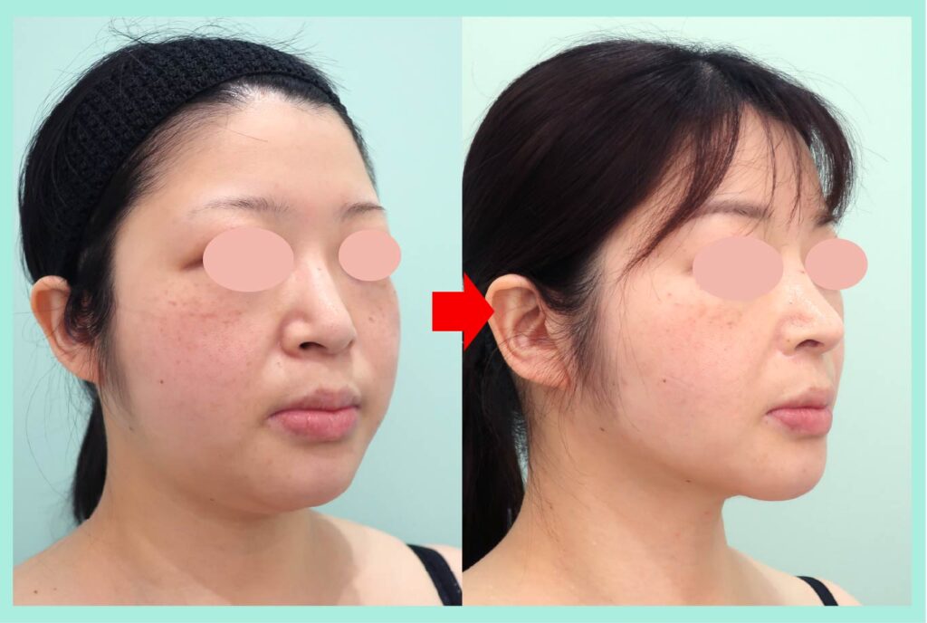 『術後3年経過しても圧倒的な結果で満足度MAXの脂肪吸引治療』の画像