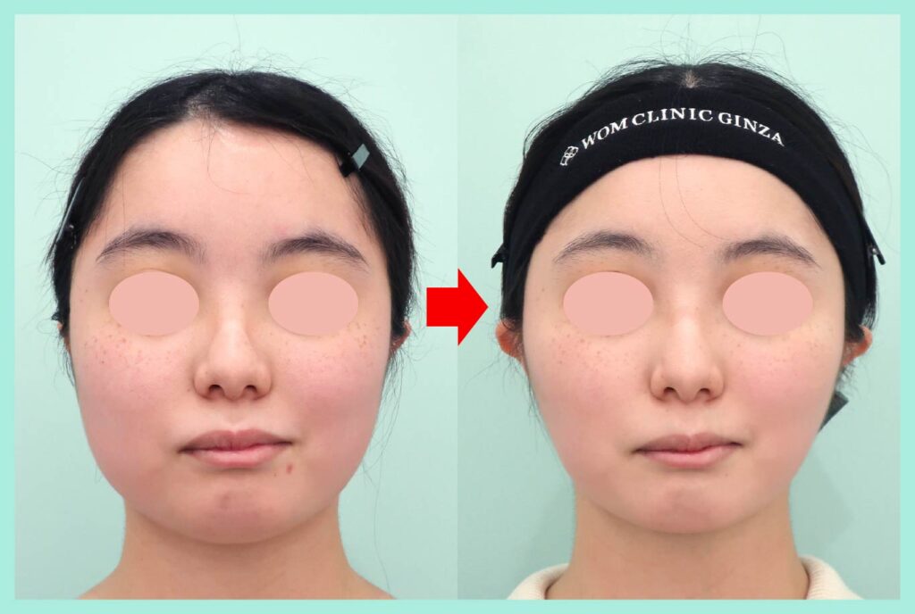 『ベース型の輪郭を骨切りなしでなるべく工夫してしっかり細くする!』の画像