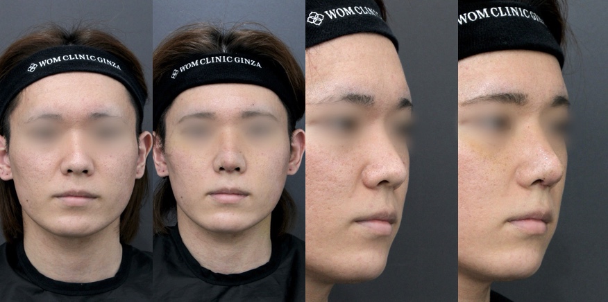 『【男性の初回鼻整形】鼻先を下げたい方へ。自然でバランスの取れた立体感を自家組織で実現』の画像