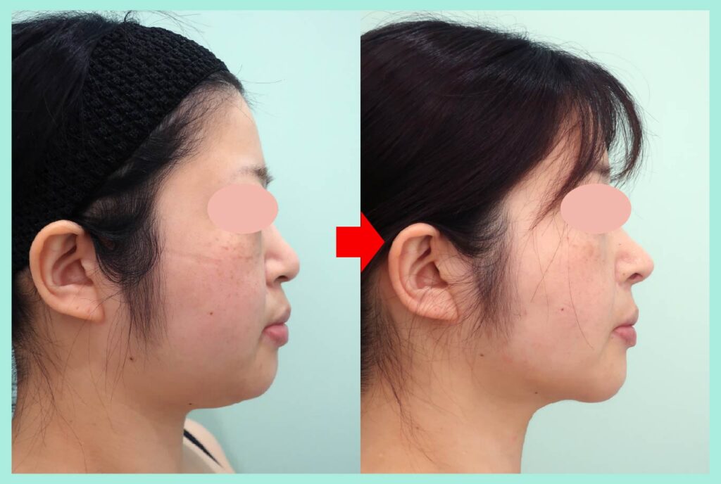 『術後3年経過しても圧倒的な結果で満足度MAXの脂肪吸引治療』の画像