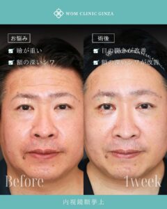 内視鏡額挙上の症例写真