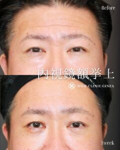 前額リフト（内視鏡額挙上）の症例写真