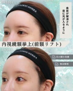 前額リフト（内視鏡額挙上）の症例写真