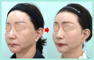 ミッドフェイスリフト＋コメカミ〜耳前部フェイスリフト＋前額リフト＋眉毛下リフトの症例写真