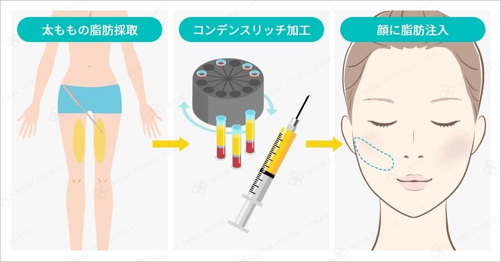 脂肪注入