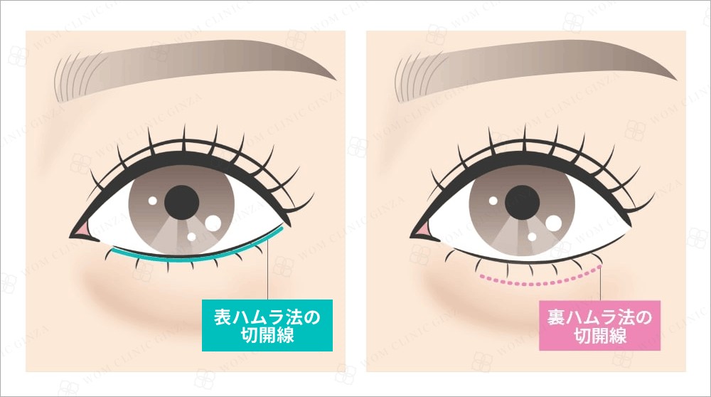 ハムラ法 切開ライン