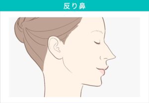 反り鼻