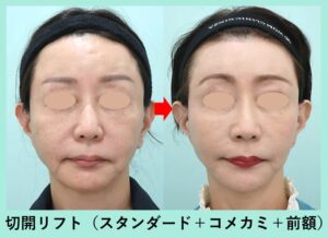 切開リフトの症例写真