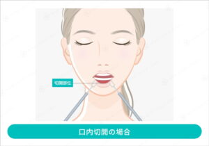 口腔内から切開する術式のイラスト