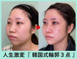 韓国式輪郭3点＋頬＋顎下の脂肪吸引＋バッカルファット除去の症例写真