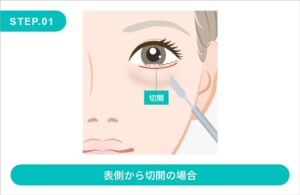 ミッドフェイスリフトの施術方法 STEP.1