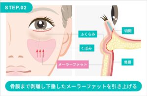 ミッドフェイスリフトの施術方法 STEP.2