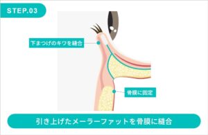 ミッドフェイスリフトの施術方法 STEP.3