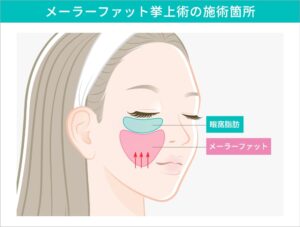 ミッドフェイスリフト（メーラーファット挙上術）の施術箇所