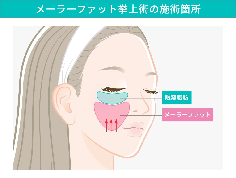 ミッドフェイスリフト（メーラーファット挙上術）の施術箇所