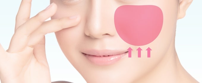 ミッドフェイスリフト