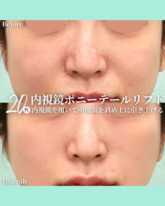 ポニーテールリフトの症例写真