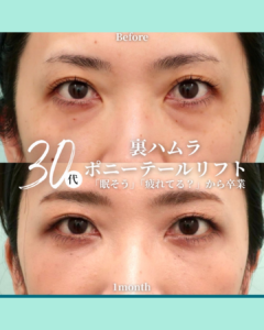 ポニーテールリフト+裏ハムラ法の症例写真