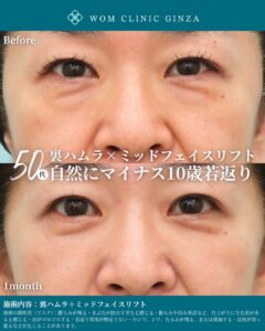 裏ハムラ法＋ミッドフェイスリフトの症例写真