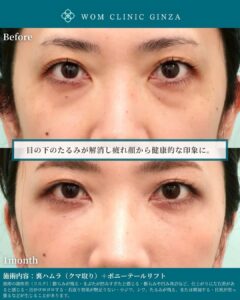 裏ハムラ法＋ポニーテールリフトの症例写真